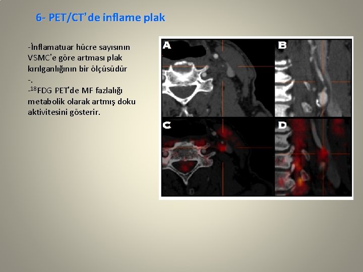 6 - PET/CT’de inflame plak -İnflamatuar hücre sayısının VSMC’e göre artması plak kırılganlığının bir
