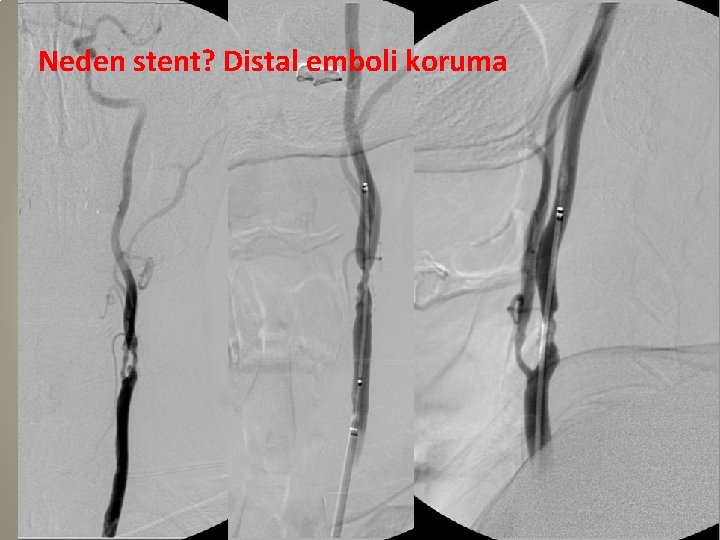 Neden stent? Distal emboli koruma 