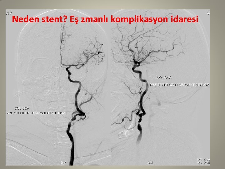 Neden stent? Eş zmanlı komplikasyon idaresi 
