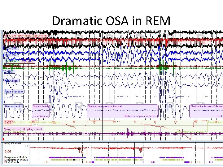 Dramatic OSA in REM 