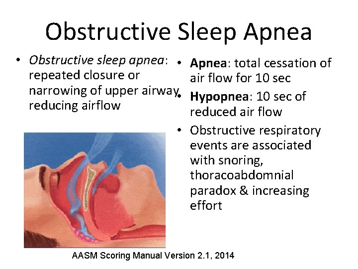 Obstructive Sleep Apnea • Obstructive sleep apnea: • repeated closure or narrowing of upper