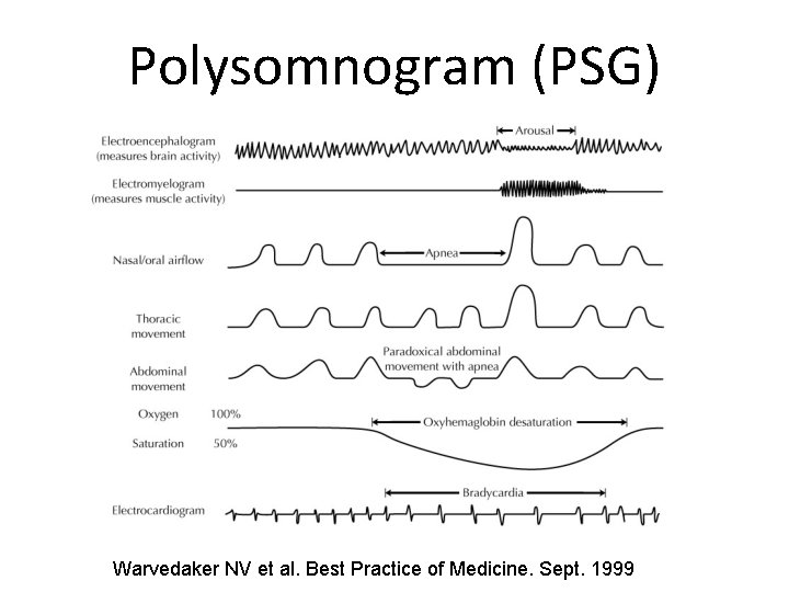 Polysomnogram (PSG) Warvedaker NV et al. Best Practice of Medicine. Sept. 1999 