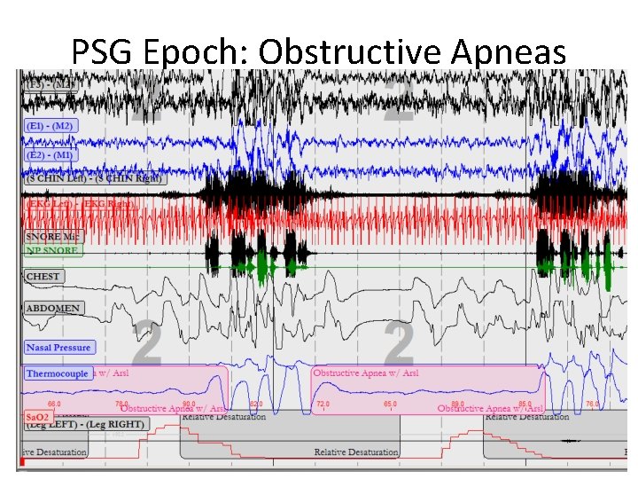 PSG Epoch: Obstructive Apneas 