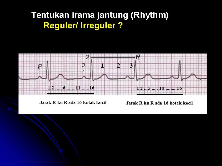 Tentukan irama jantung (Rhythm) Reguler/ Irreguler ? 