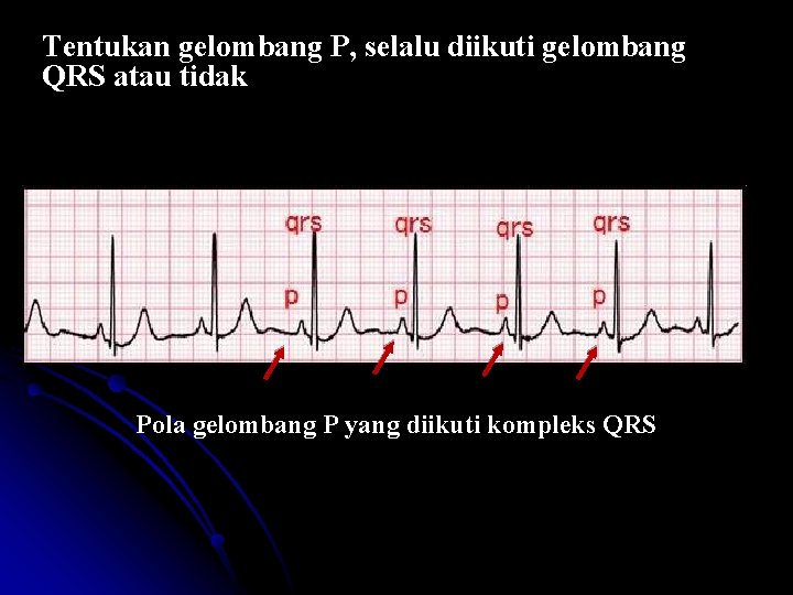 Tentukan gelombang P, selalu diikuti gelombang QRS atau tidak Pola gelombang P yang diikuti