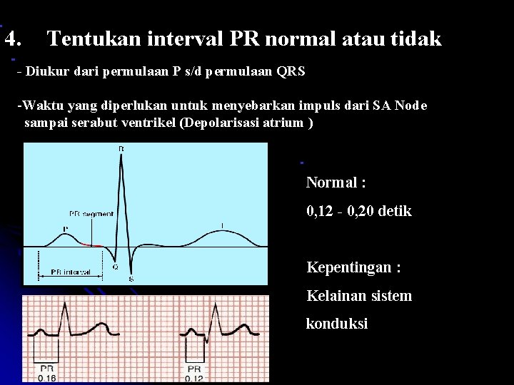 4. Tentukan interval PR normal atau tidak - Diukur dari permulaan P s/d permulaan