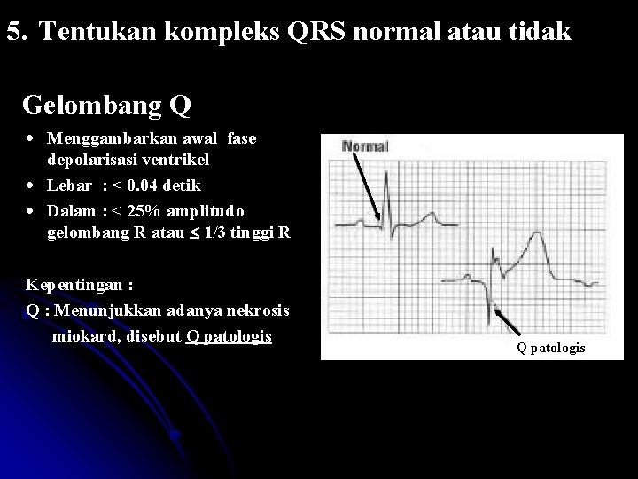 5. Tentukan kompleks QRS normal atau tidak Gelombang Q Menggambarkan awal fase depolarisasi ventrikel