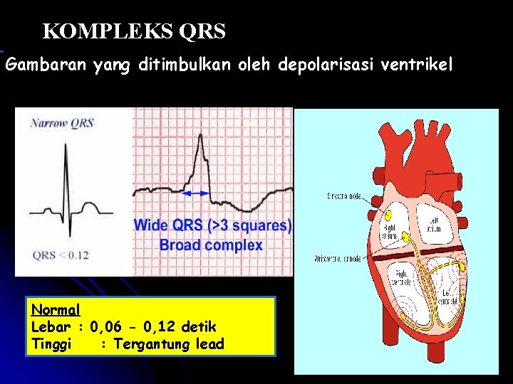 KOMPLEKS QRS Gambaran yang ditimbulkan oleh depolarisasi ventrikel Normal Lebar : 0, 06 -