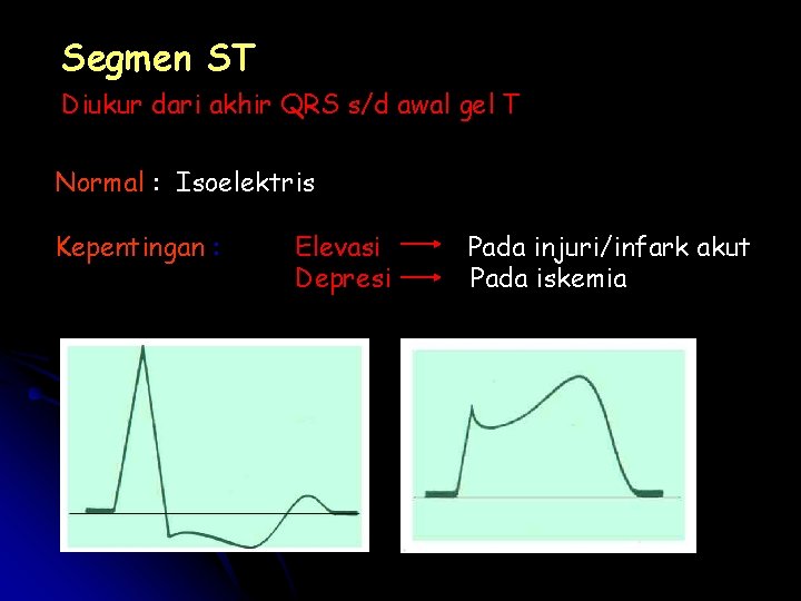 Segmen ST Diukur dari akhir QRS s/d awal gel T Normal : Isoelektris Kepentingan