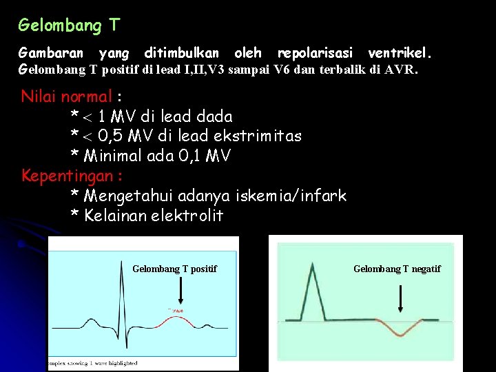 Gelombang T Gambaran yang ditimbulkan oleh repolarisasi ventrikel. Gelombang T positif di lead I,