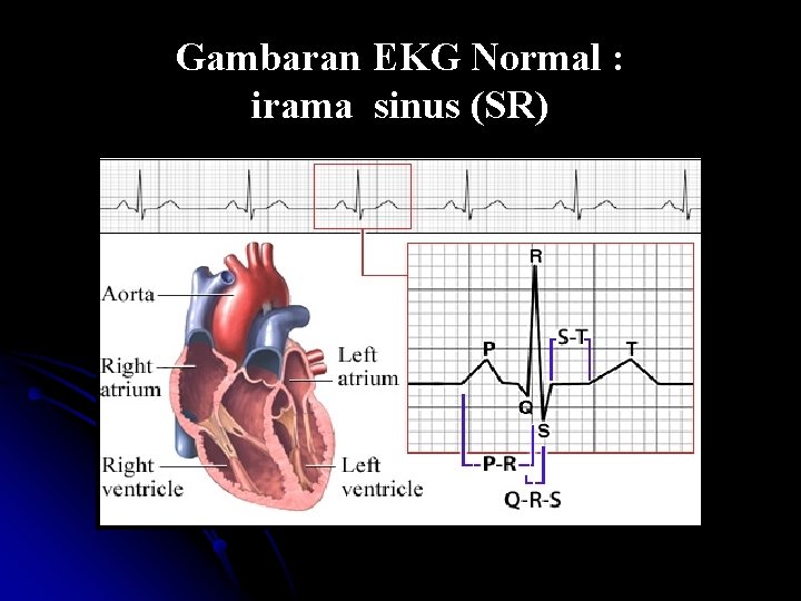 Gambaran EKG Normal : irama sinus (SR) 