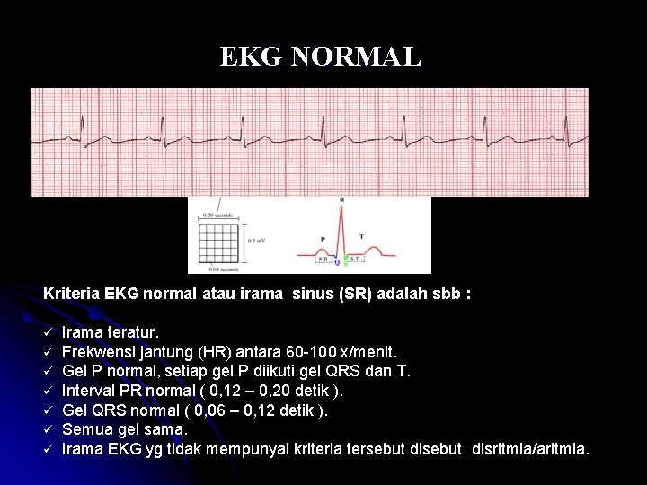 EKG NORMAL Kriteria EKG normal atau irama sinus (SR) adalah sbb : ü ü