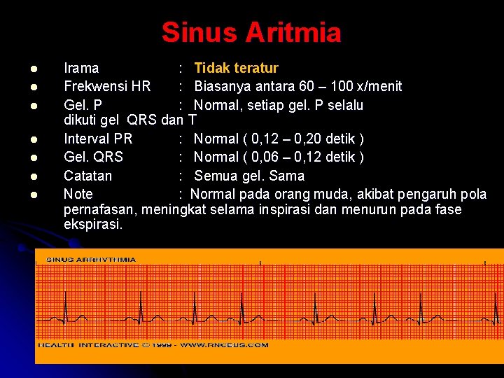 Sinus Aritmia l l l l Irama : Tidak teratur Frekwensi HR : Biasanya