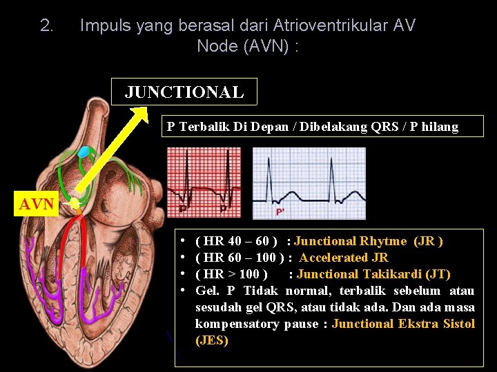 2. Impuls yang berasal dari Atrioventrikular AV Node (AVN) : JUNCTIONAL P Terbalik Di