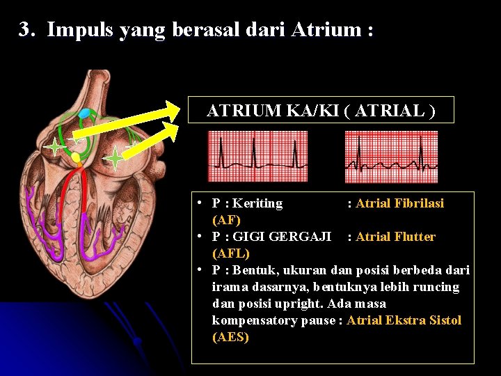 3. Impuls yang berasal dari Atrium : ATRIUM KA/KI ( ATRIAL ) • P