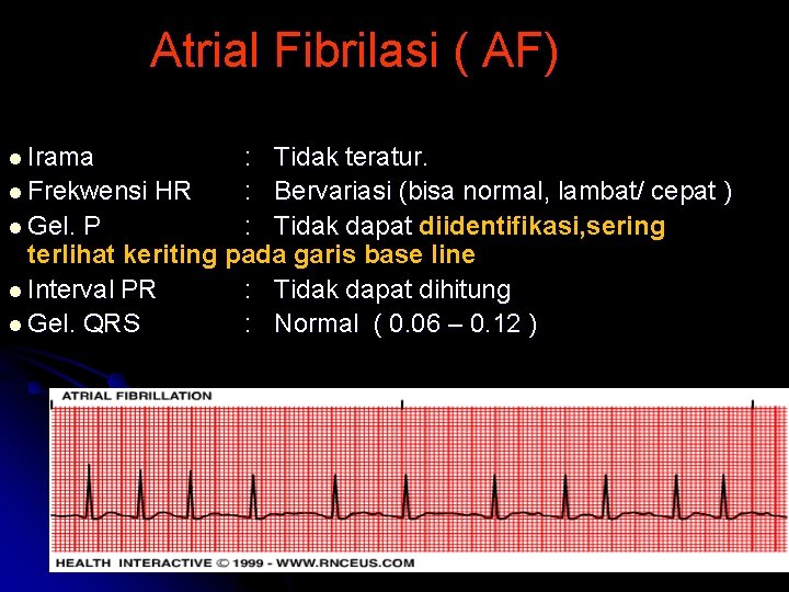Atrial Fibrilasi ( AF) l Irama : Tidak teratur. l Frekwensi HR : Bervariasi