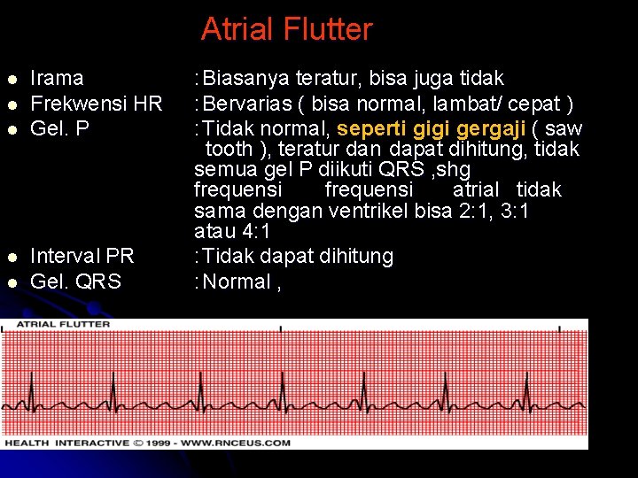 Atrial Flutter l l l Irama Frekwensi HR Gel. P Interval PR Gel. QRS