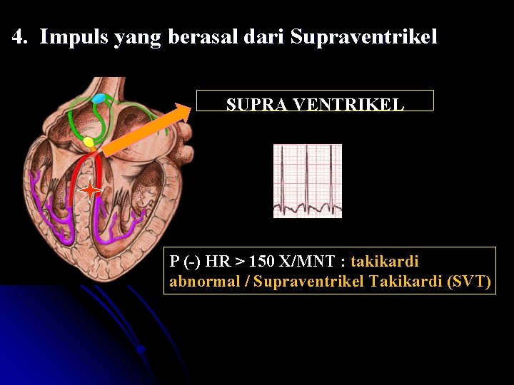 4. Impuls yang berasal dari Supraventrikel SUPRA VENTRIKEL P (-) HR > 150 X/MNT