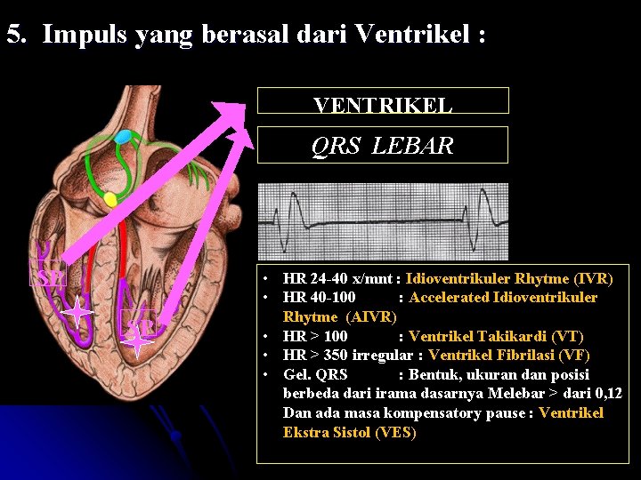 5. Impuls yang berasal dari Ventrikel : VENTRIKEL QRS LEBAR SP SP • HR