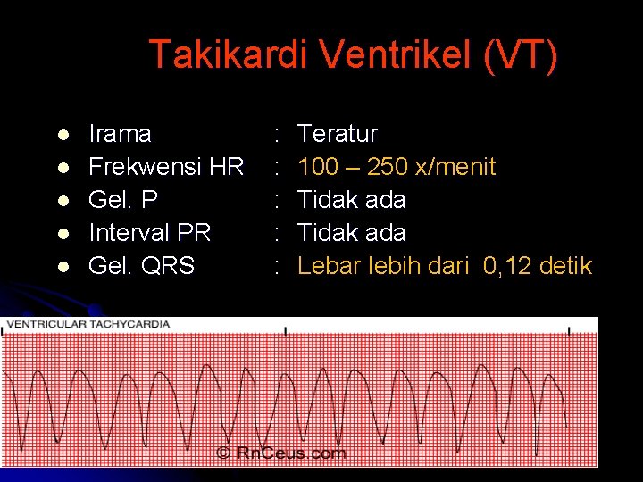 Takikardi Ventrikel (VT) l l l Irama Frekwensi HR Gel. P Interval PR Gel.