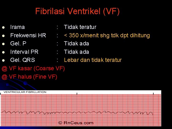 Fibrilasi Ventrikel (VF) Irama : Tidak teratur l Frekwensi HR : < 350 x/menit