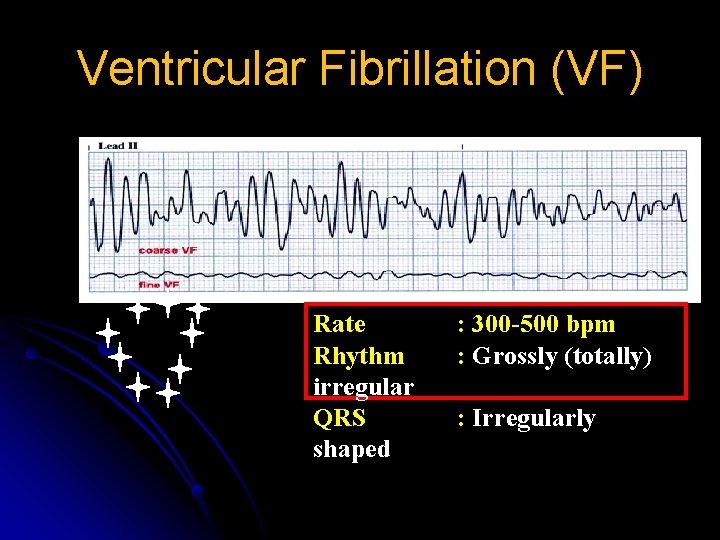 Ventricular Fibrillation (VF) Rate Rhythm irregular QRS shaped : 300 -500 bpm : Grossly