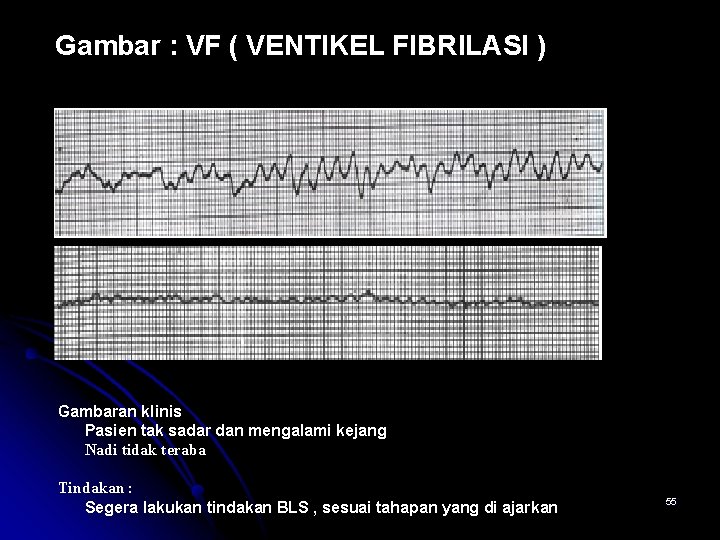 Gambar : VF ( VENTIKEL FIBRILASI ) Gambaran klinis Pasien tak sadar dan mengalami