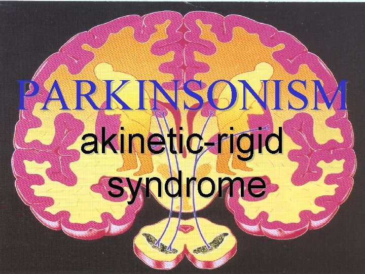 PARKINSONISM akinetic-rigid syndrome 