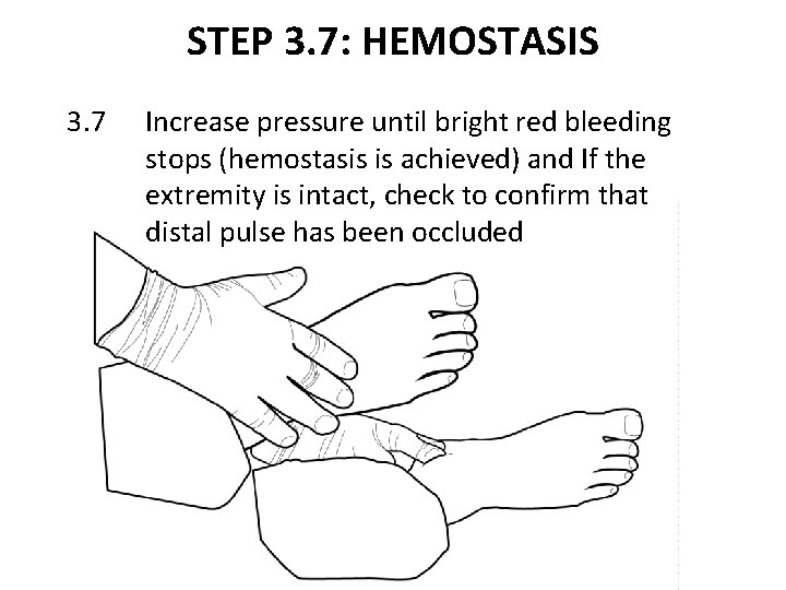 STEP 3. 7: HEMOSTASIS 3. 7 Increase pressure until bright red bleeding stops (hemostasis
