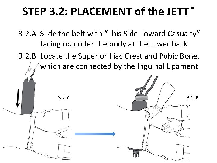 STEP 3. 2: PLACEMENT of the JETT™ 3. 2. A Slide the belt with