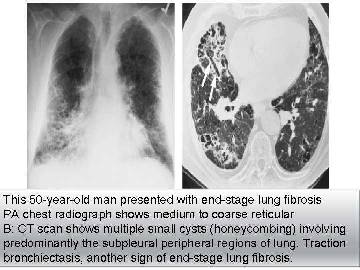 This 50 -year-old man presented with end-stage lung fibrosis PA chest radiograph shows medium