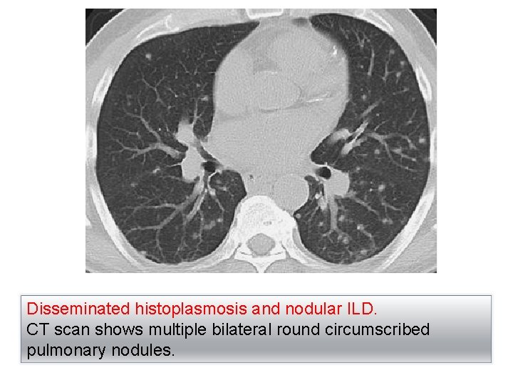 Disseminated histoplasmosis and nodular ILD. CT scan shows multiple bilateral round circumscribed pulmonary nodules.