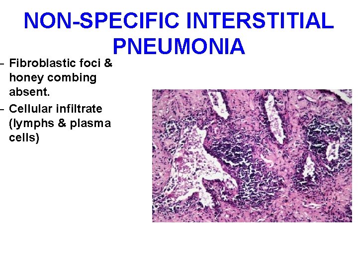 NON-SPECIFIC INTERSTITIAL PNEUMONIA – Fibroblastic foci & honey combing absent. – Cellular infiltrate (lymphs