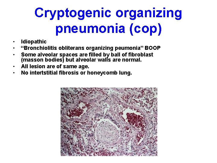 Cryptogenic organizing pneumonia (cop) • • • Idiopathic “Bronchiolitis obliterans organizing peumonia” BOOP Some