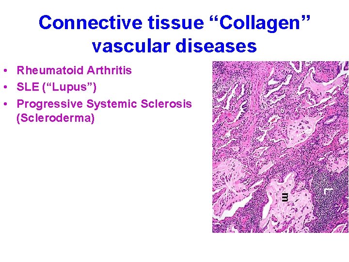 Connective tissue “Collagen” vascular diseases • Rheumatoid Arthritis • SLE (“Lupus”) • Progressive Systemic