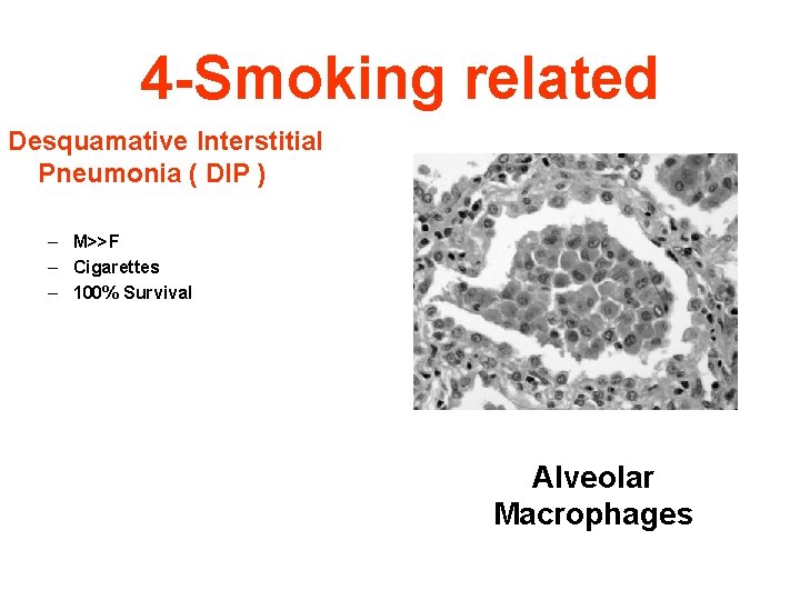 4 -Smoking related Desquamative Interstitial Pneumonia ( DIP ) – M>>F – Cigarettes –