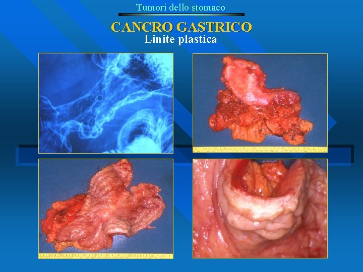 Tumori dello stomaco CANCRO GASTRICO Linite plastica 