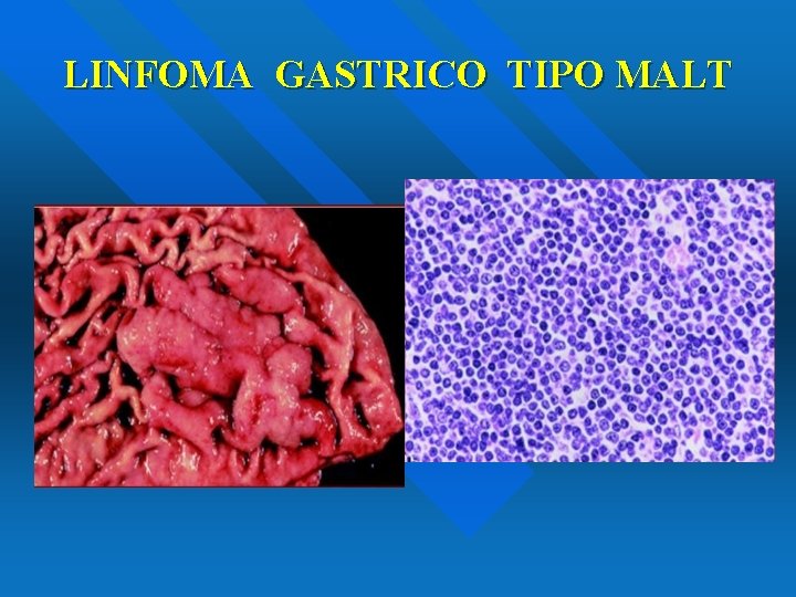 LINFOMA GASTRICO TIPO MALT 