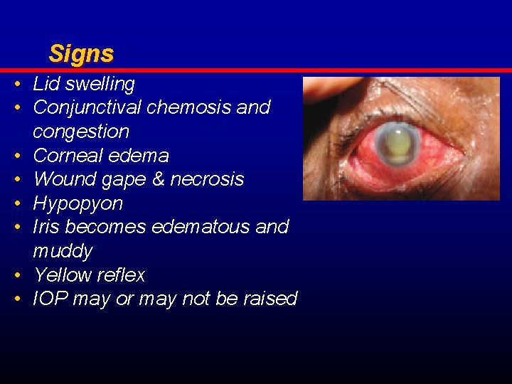 Signs • Lid swelling • Conjunctival chemosis and congestion • Corneal edema • Wound