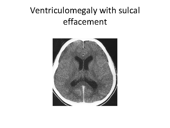Ventriculomegaly with sulcal effacement 