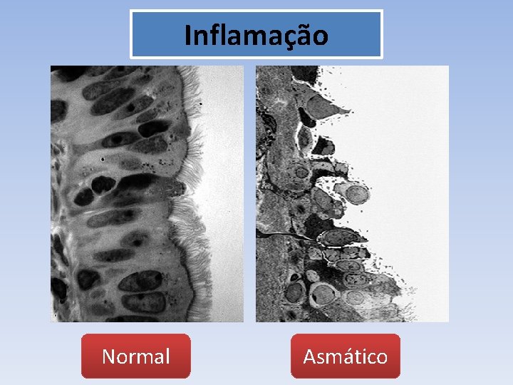 Inflamação Normal Asmático 