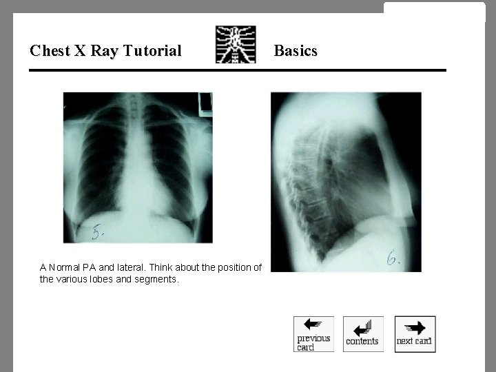 Chest X Ray Tutorial A Normal PA and lateral. Think about the position of