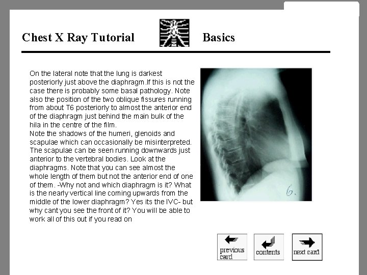 Chest X Ray Tutorial On the lateral note that the lung is darkest posteriorly