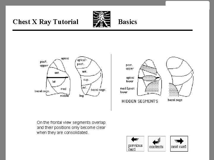 Chest X Ray Tutorial On the frontal view segments overlap and their positions only