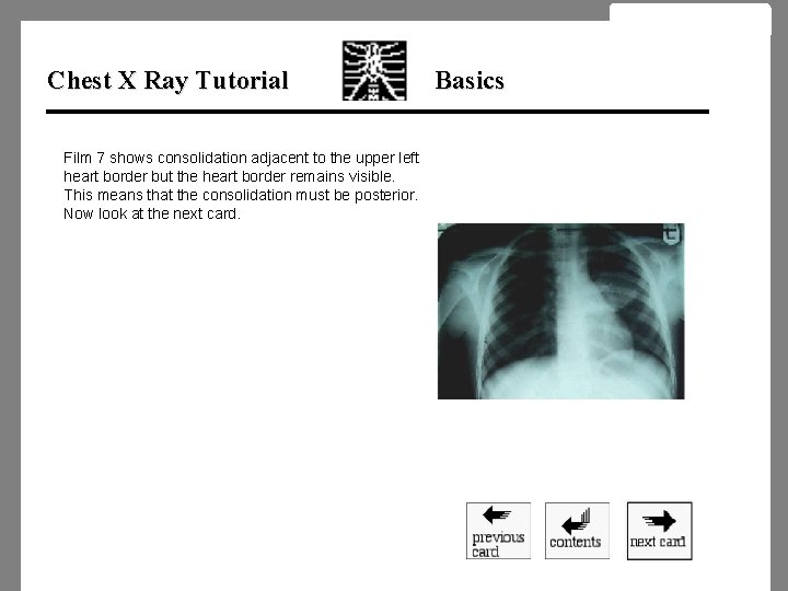 Chest X Ray Tutorial Film 7 shows consolidation adjacent to the upper left heart