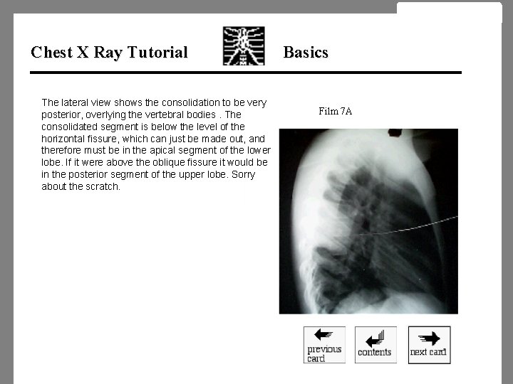 Chest X Ray Tutorial The lateral view shows the consolidation to be very posterior,