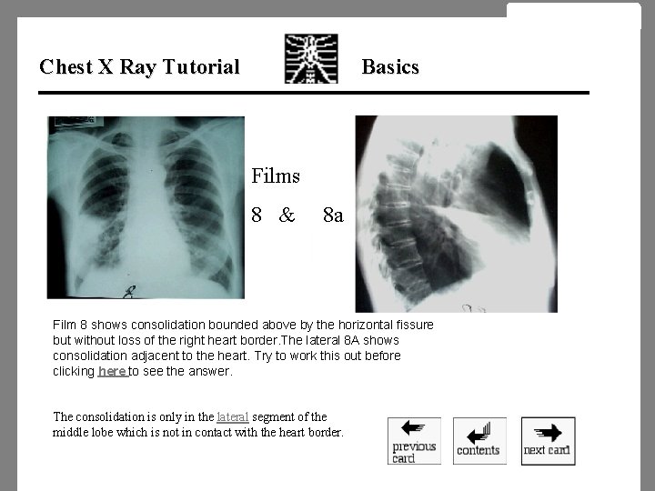 Chest X Ray Tutorial Basics Films 8 & 8 a Film 8 shows consolidation