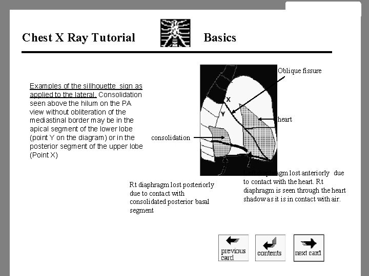 Chest X Ray Tutorial Basics Oblique fissure Examples of the sillhouette sign as applied