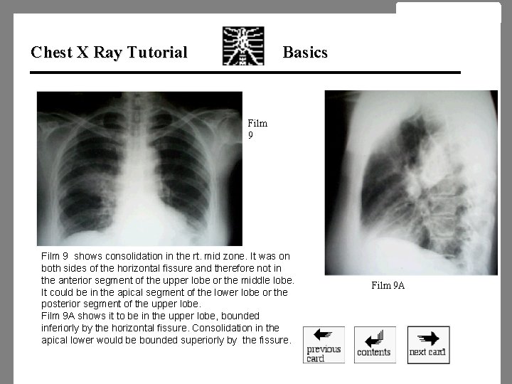 Chest X Ray Tutorial Basics Film 9 shows consolidation in the rt. mid zone.