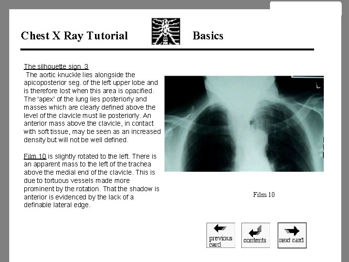 Chest X Ray Tutorial Basics The silhouette sign 3 The aortic knuckle lies alongside